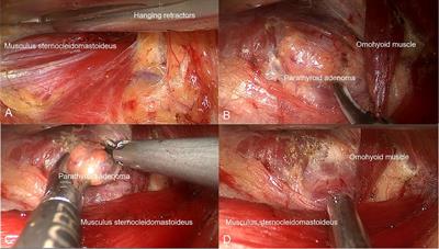 Clinical application of endoscopic surgery using a gasless unilateral transaxillary approach in the treatment of primary hyperparathyroidism
